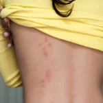 Can You Get Bed Bugs from Camping?